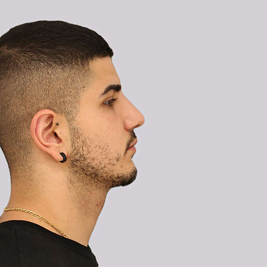 Dr Ha Rhinoplasty Before & After (Male) - Adelaide