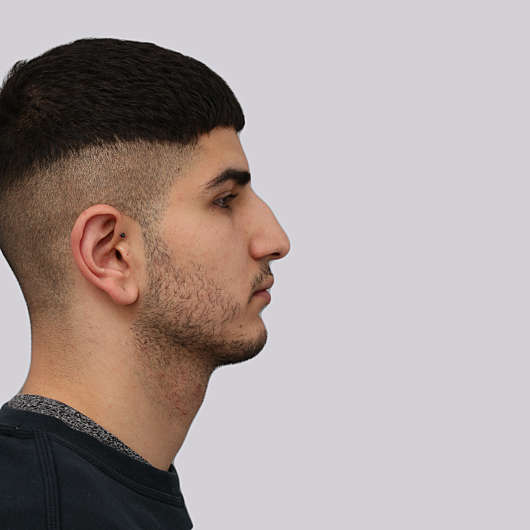 Dr Ha Rhinoplasty Before & After (Male) - Adelaide