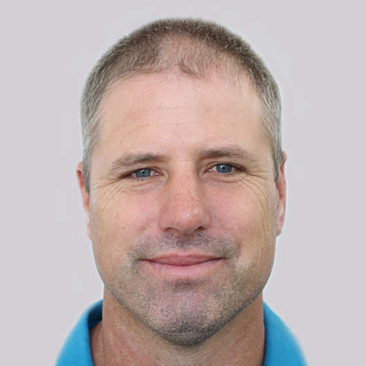 Dr Ha Rhinoplasty Before & After - Adelaide