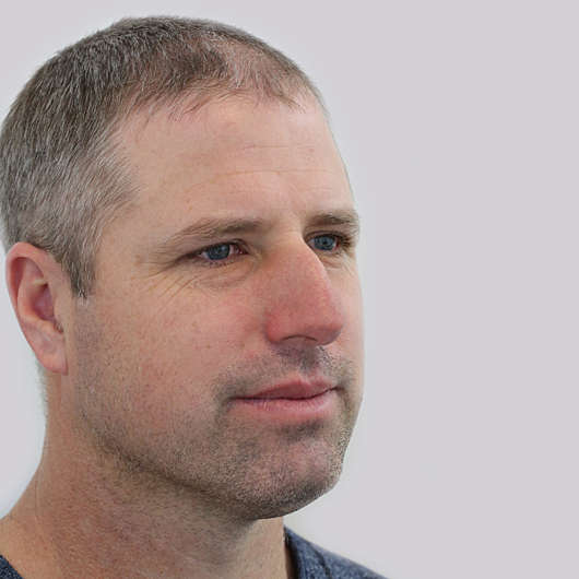 Dr Ha Rhinoplasty Before & After - Adelaide