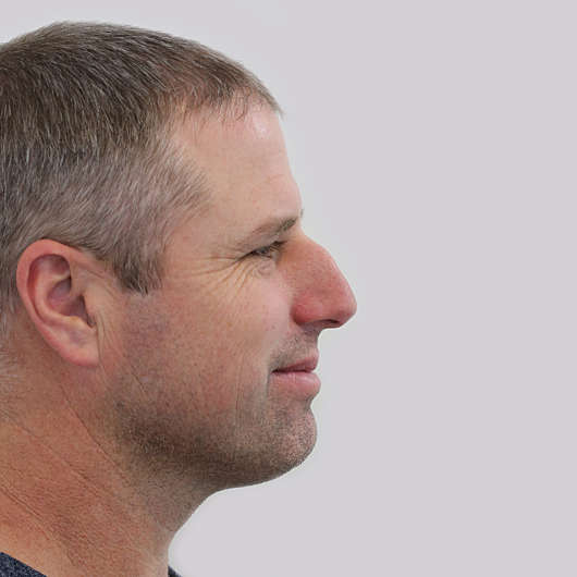 Dr Ha Rhinoplasty Before & After - Adelaide