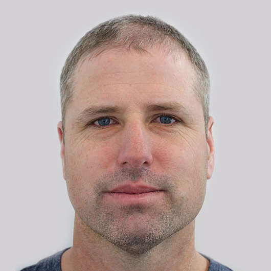 Dr Ha Rhinoplasty Before & After - Adelaide