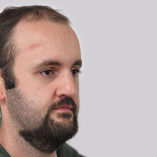 Dr Ha Rhinoplasty Before & After (Male) - Adelaide