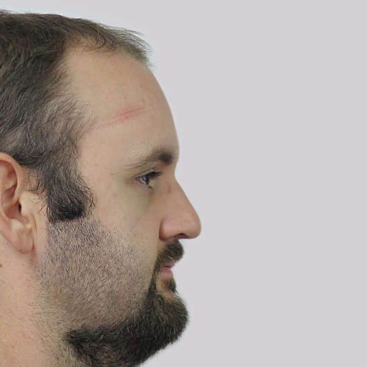 Dr Ha Rhinoplasty Before & After (Male) - Adelaide