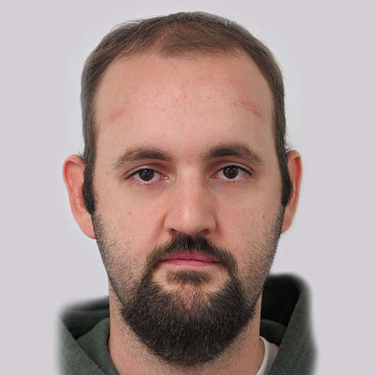 Dr Ha Rhinoplasty Before & After (Male) - Adelaide