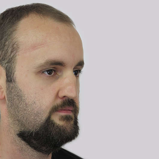 Dr Ha Rhinoplasty Before & After (Male) - Adelaide