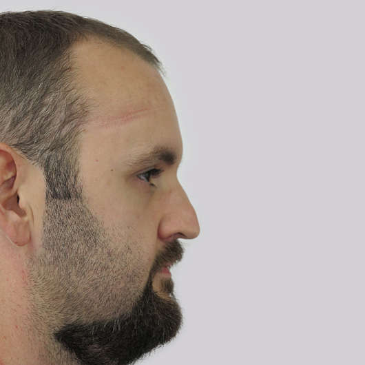 Dr Ha Rhinoplasty Before & After (Male) - Adelaide